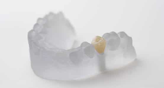 Bild: In der Zahnarztpraxis Bierbaum & Kollegen fertigen wir Zahnersatz jeglicher Art